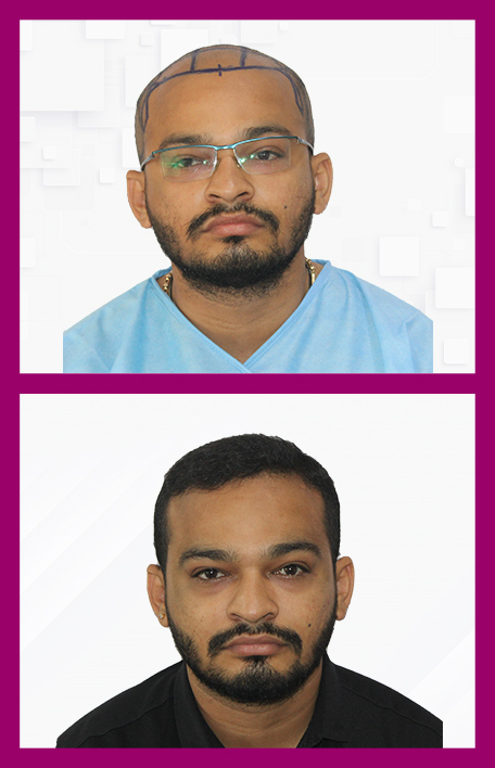 Hair-Transplant-In-Male